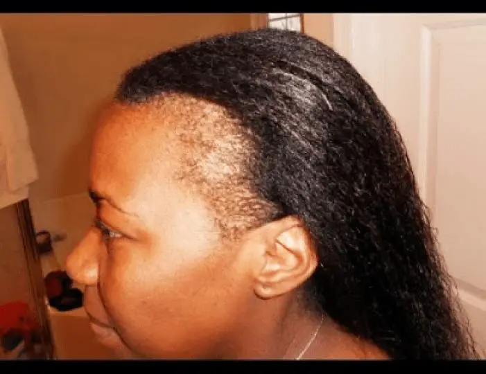 causes ofthinning hair
