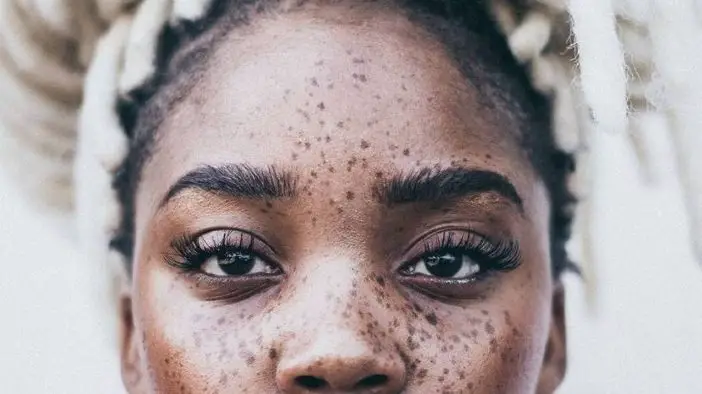 types of hyperpigmentation