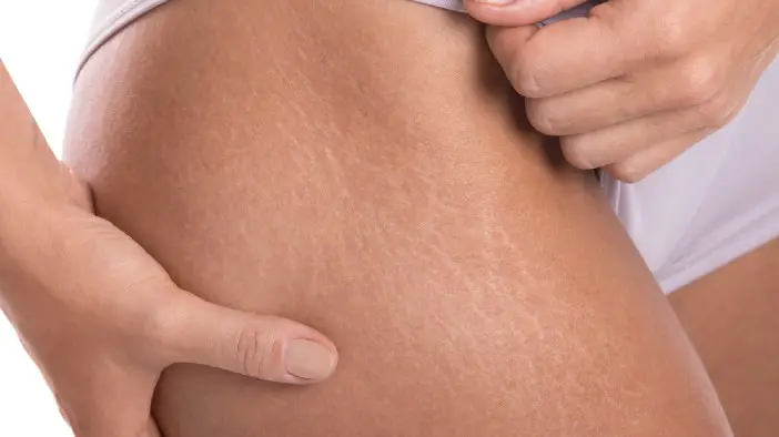 stretch marks