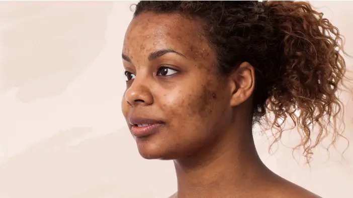 acne skin care routine